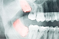 Wisdom Tooth Extractions