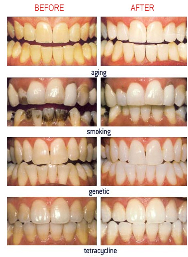 before after