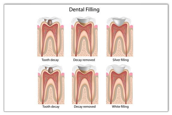 dental fillings