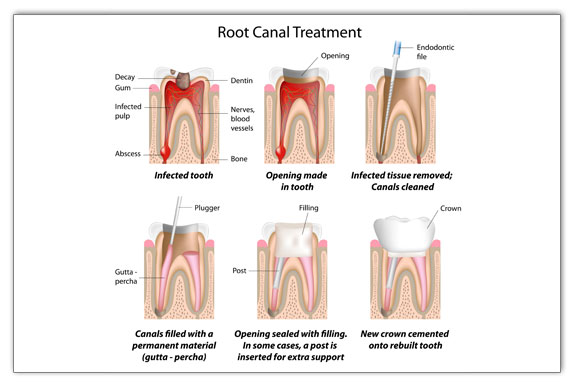 root canal