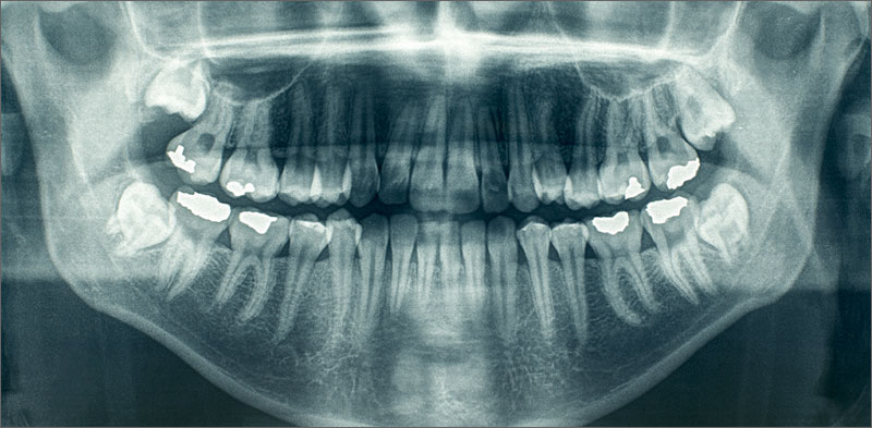 Dental Xrays