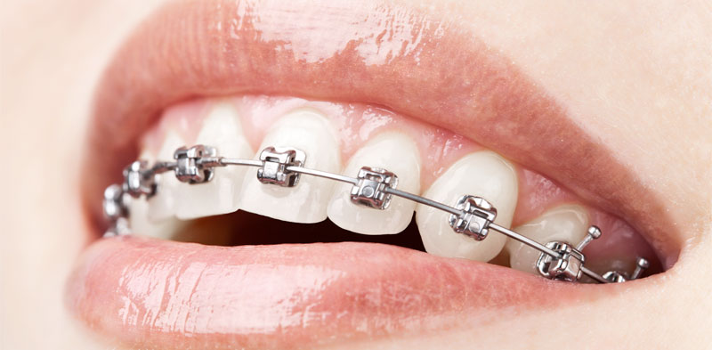 https://www.drsoniasharma.com/wp-content/uploads/2016/01/Orthodontic-Braces-Brampton.jpg