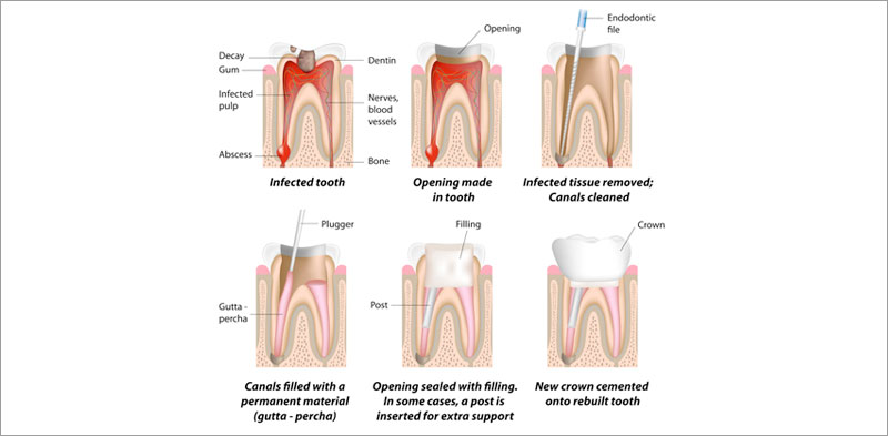 Root Canal Treatment