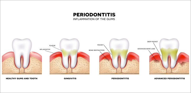 Gum Disease