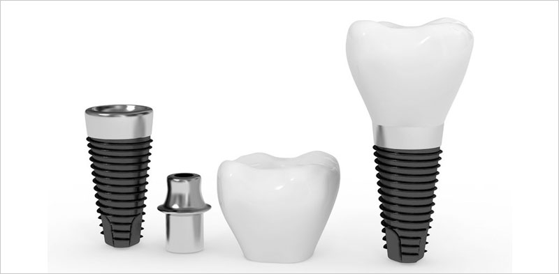 $1000 Dental Implants