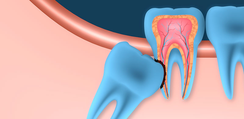 Wisdom Teeth Removal Cost