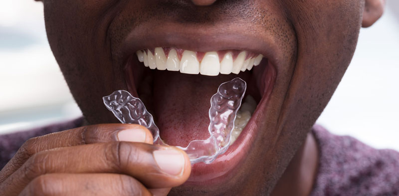 Invisalign