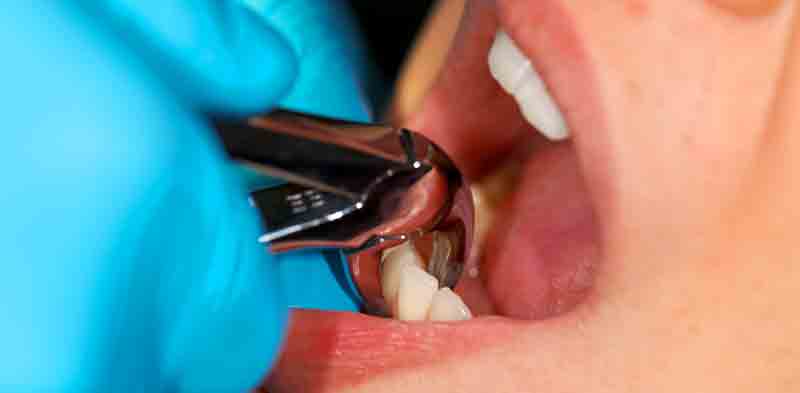 Emergency Dental Extractions