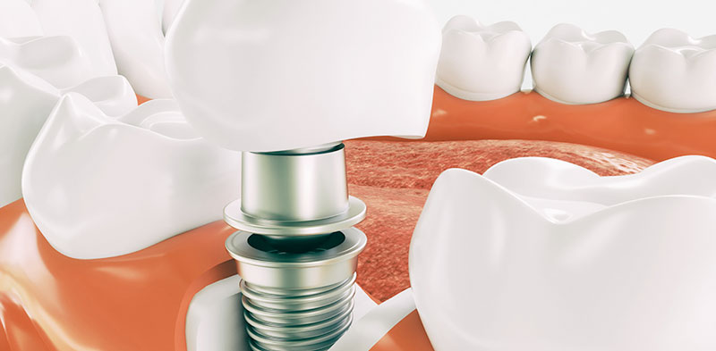 Types of Dental Implants