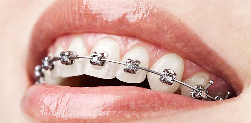 Braces by Brampton Dental Office