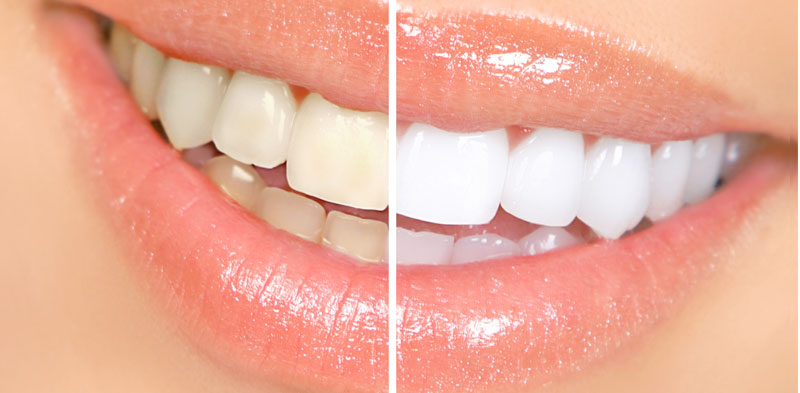 Where to go for teeth whitening
