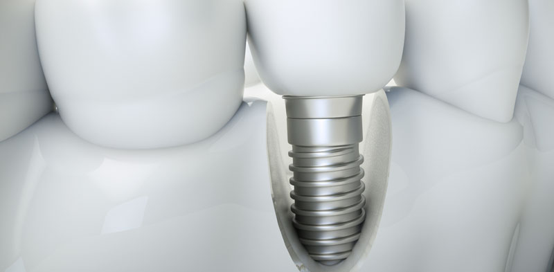 cost of Tooth Implants